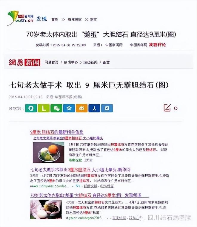 澳门·威尼斯人(中国)官方网站四川结石病医院案例分享：古稀老人体内取出巨型“石头”(图2)