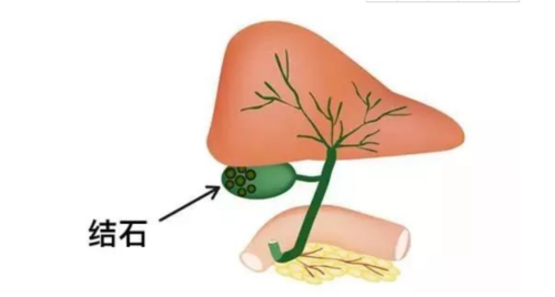 小小一个草却是胆澳门威尼斯人官网结石、胆囊炎的克星！(图3)